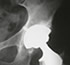 Implantes ortopedicos en guadalajara