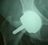 prótesis ortopédicas de rodilla guadalajara
