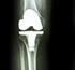 prótesis ortopédicas de cadera guadalajara