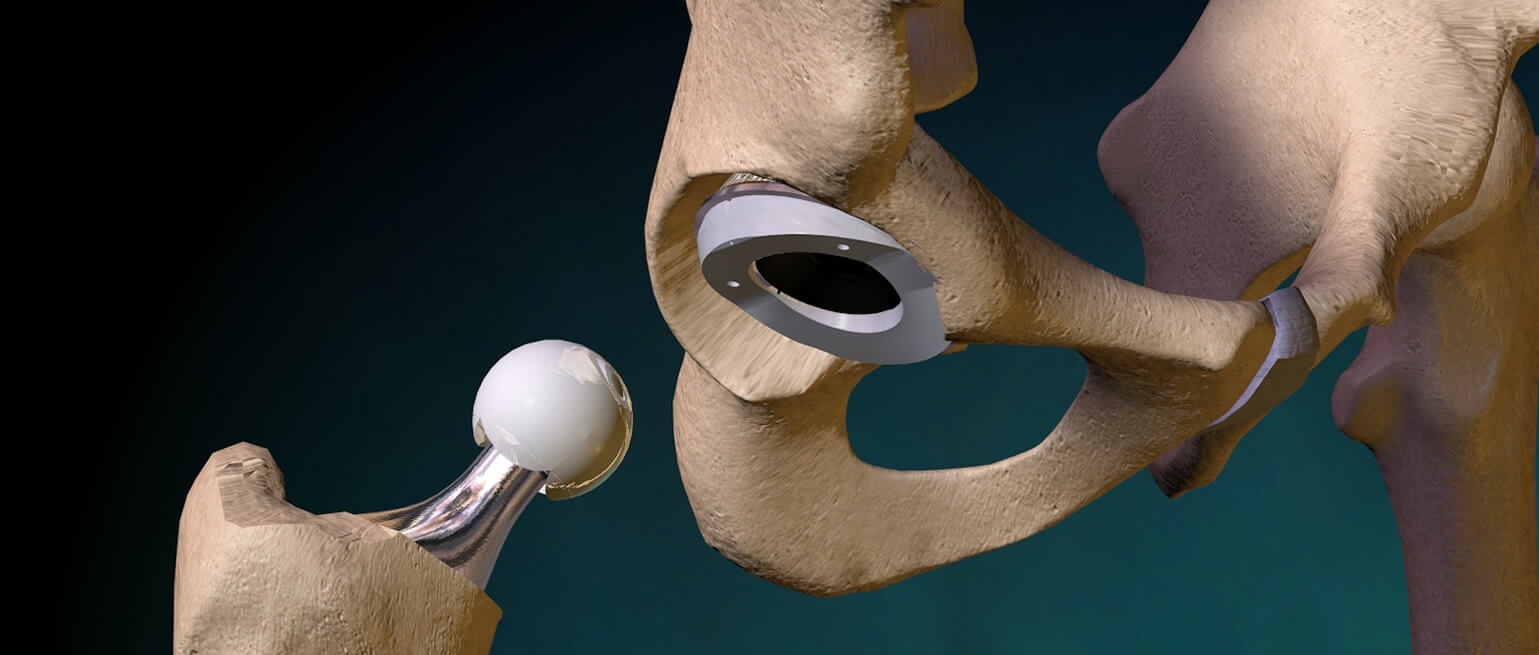 Эндопротезирование тазобедренного сустава DEPUY. Эндопротез тазобедренный Титан керамика. Эндопротезирование тазобедренного сустава керамика. Implantcast тазобедренный сустав. Замена сустава шейки бедра