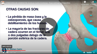 Fractura de cadera en Guadalajara - Traumatólogo y Ortopedista