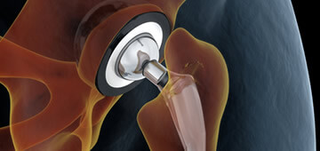 Implantes ortopedicos