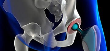 prótesis ortopédicas de cadera