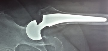Implantes ortopedicos