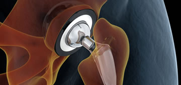 Hip replacement guadalajara