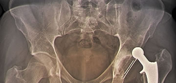 Prótesis ortopédicas de cadera in Guadalajara