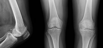 knee pain guadalajara