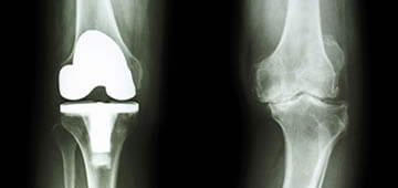 Guadalajara knee prosthesis