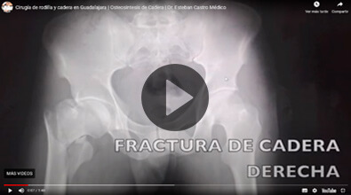 Knee and hip surgery in Guadalajara - Traumatologist and Orthopedist